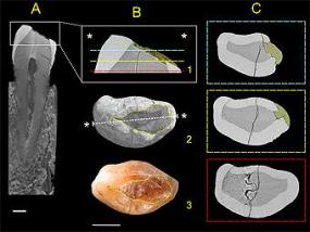 Антропологи обнаружили зубную пломбу эпохи неолита