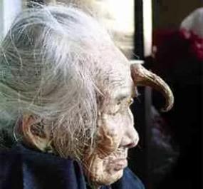 У пожилой китаянки на лбу вырос рог