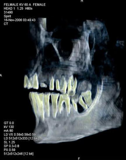Рентгеновский снимок черепа мумии женщины-фараона Хатшепсут.