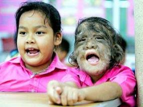 В Таиланде живет «девочка-волк», лицо которой полностью покрыто волосами